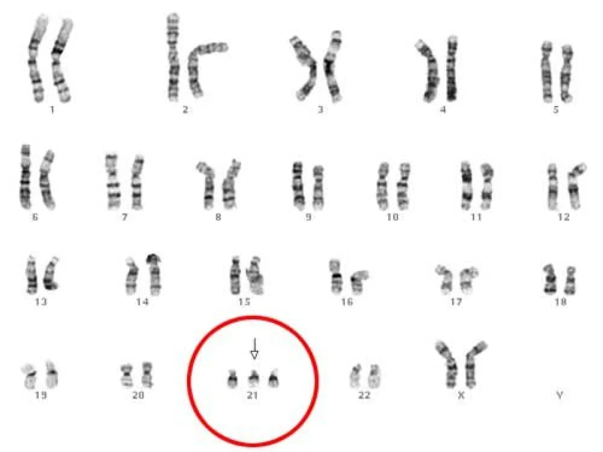 Qu'est-ce que la trisomie 21 ?