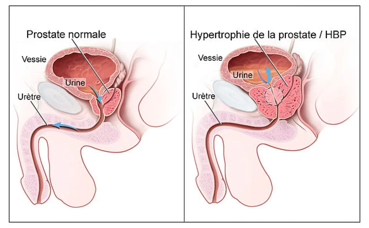 À la découverte de l’hypertrophie bénigne de la prostate