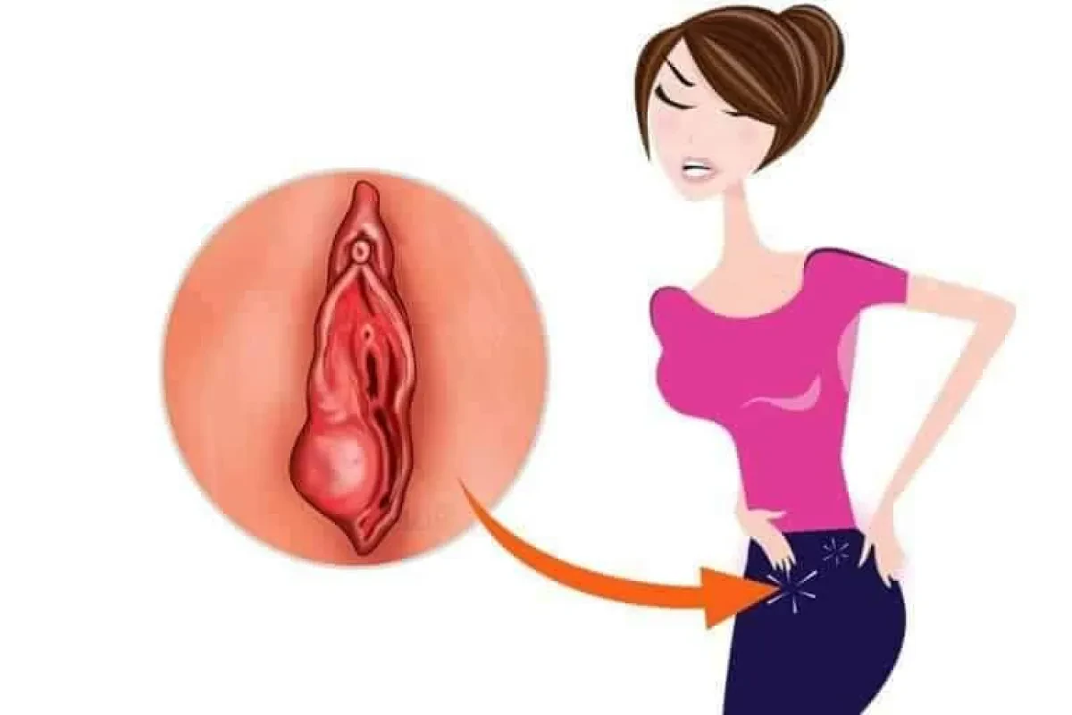 La Bartholinite: une infection génitale assez fréquente !