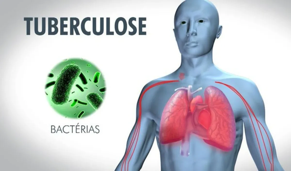 Eradication de la maladie : Le Pnt indique les voies et moyens d’en finir avec la tuberculose